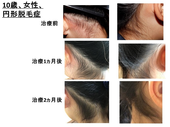 円形脱毛症　病院